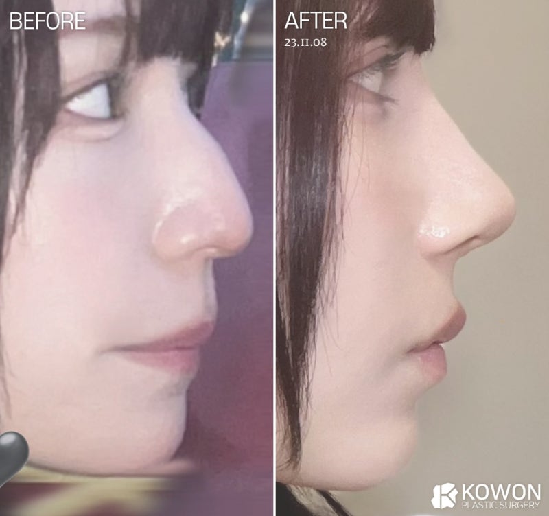 코절골술, 매부리코 정말 뼈를 깎는 과정이 필수일까요? 사진 10