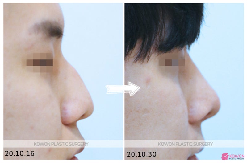 비절개 코수술, 비개방 코수술과 차이점, 흉터 없이 오뚝해질 수 있을까? 사진 7