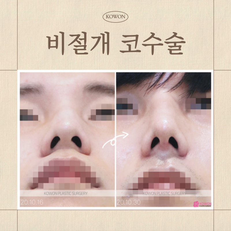 비절개 코수술, 비개방 코수술과 차이점, 흉터 없이 오뚝해질 수 있을까?