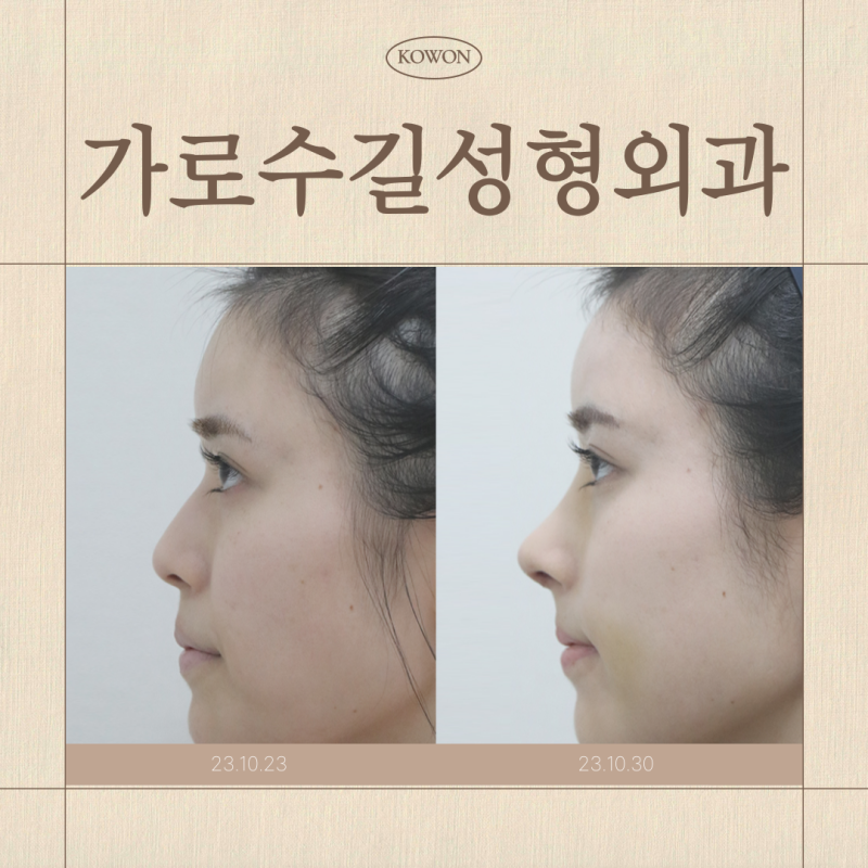 가로수길성형외과 코성형, 병원 선택 전 꼭 확인해야 할 4가지 기준