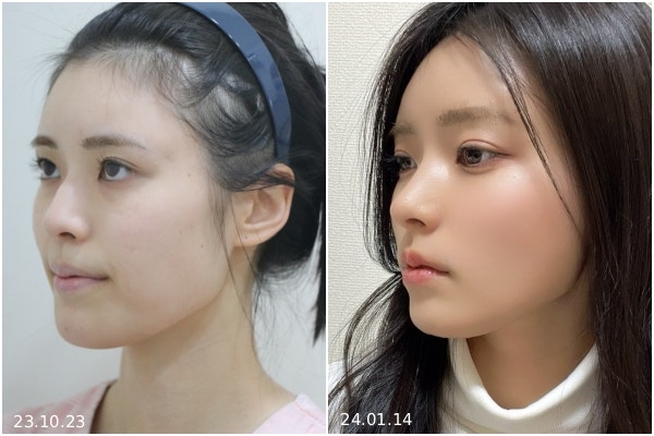 가로수길성형외과 코성형, 병원 선택 전 꼭 확인해야 할 4가지 기준 사진 7