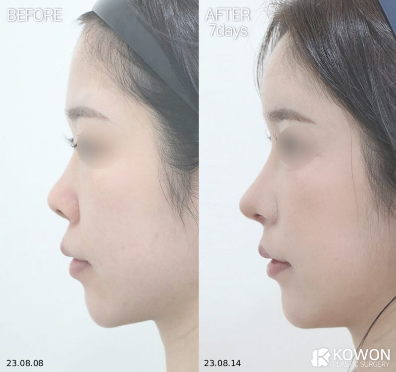 자연스러운코 완성하는 자가늑입자, 실패 없는 선택 기준은 무엇인가요? 사진 4