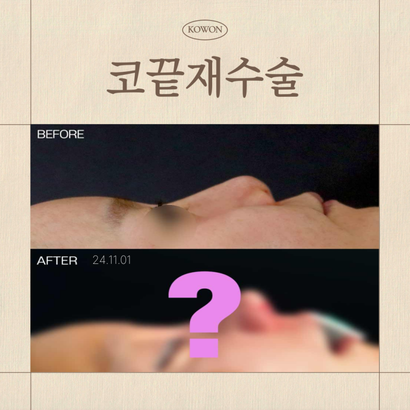 코끝재수술 코끝염증 방치해도 될까