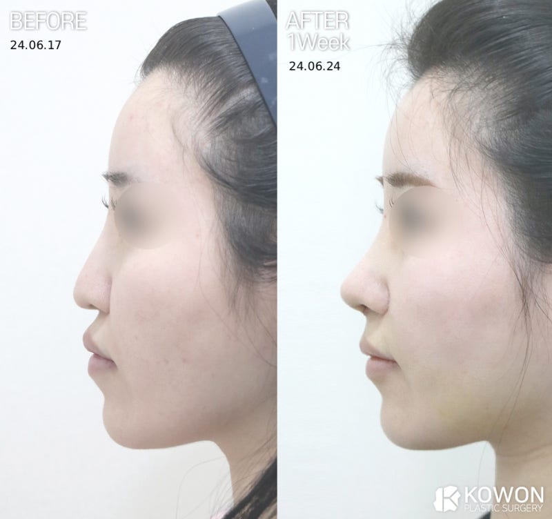 콧대수술비용 기준은? 콧대 코끝 성형 비용 차이 이유 사진 3