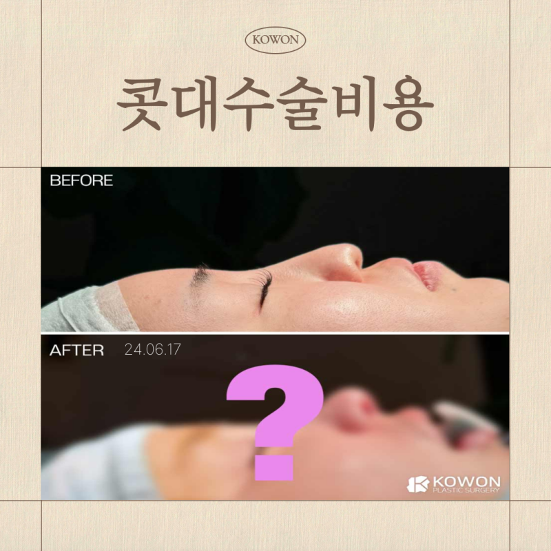 콧대수술비용 기준은? 콧대 코끝 성형 비용 차이 이유