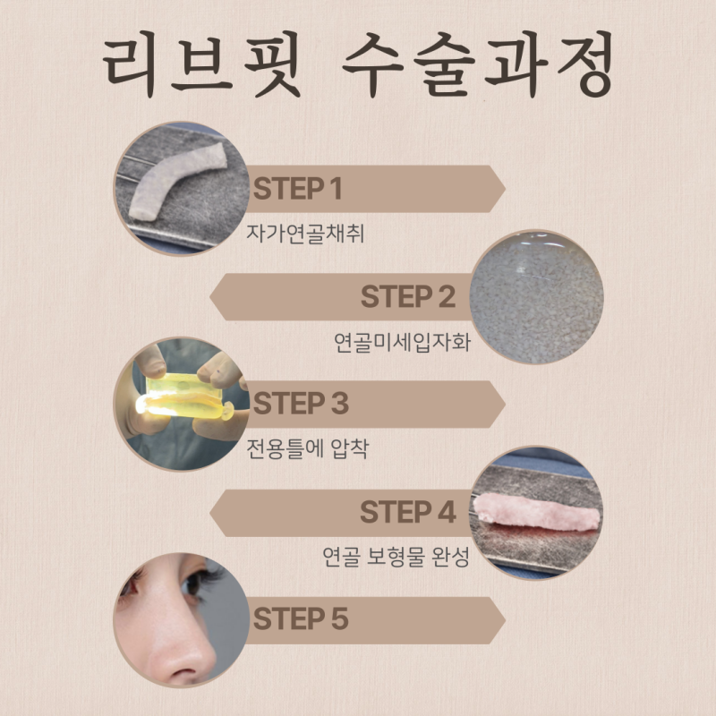 콧대수술비용 기준은? 콧대 코끝 성형 비용 차이 이유 사진 4