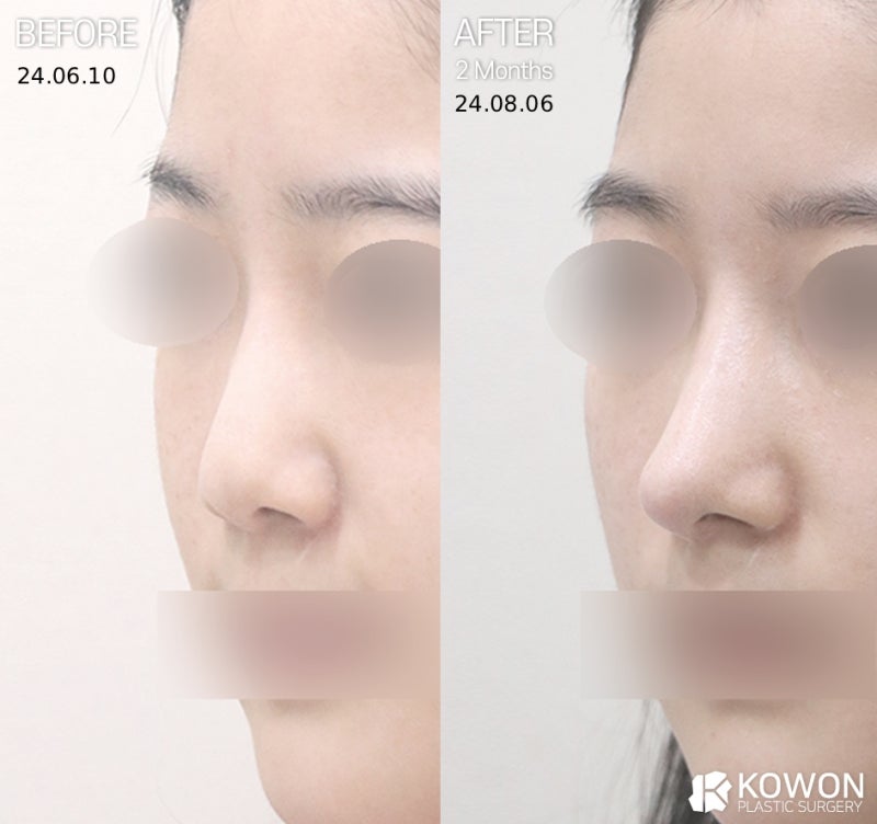 자려한코, 낮은코도 가능할까? 자연스러움과 입체감을 만드는 기준 사진 5