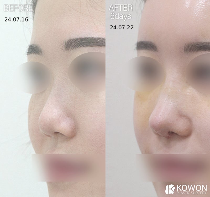 기증늑연골 장점 단점 무엇일까? 코성형 연골 선택 기준 정리 사진 8