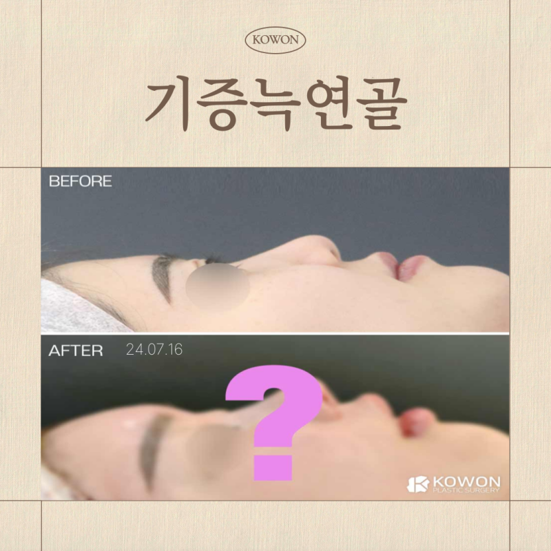 기증늑연골 장점 단점 무엇일까? 코성형 연골 선택 기준 정리