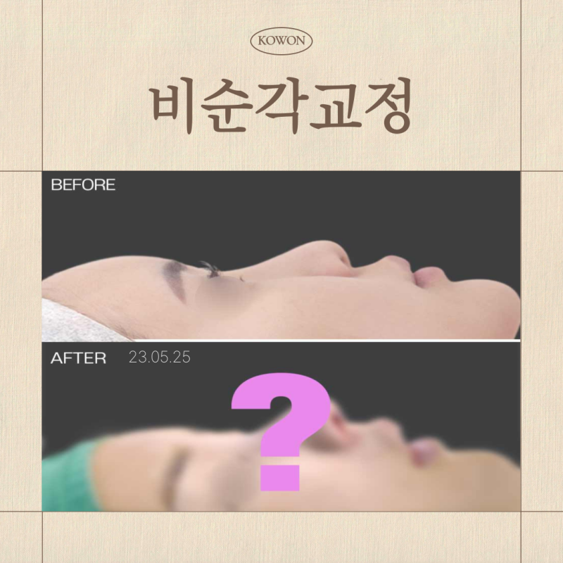 비순각교정, 고양이수술 차이와 필요한 경우 기준