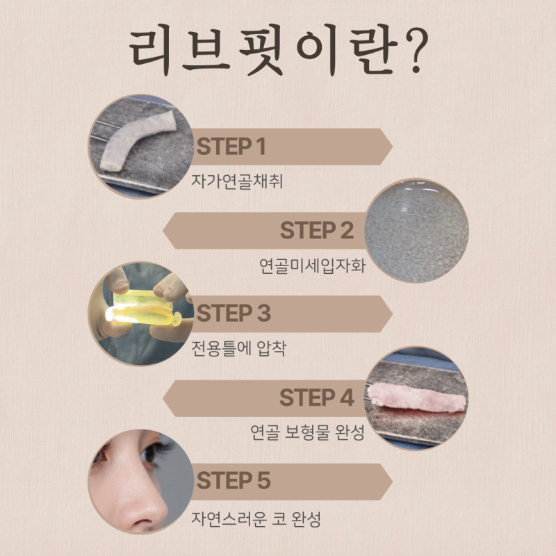 코재수술성형외과 선택 기준, 리브핏을 고려하는 이유 사진 7