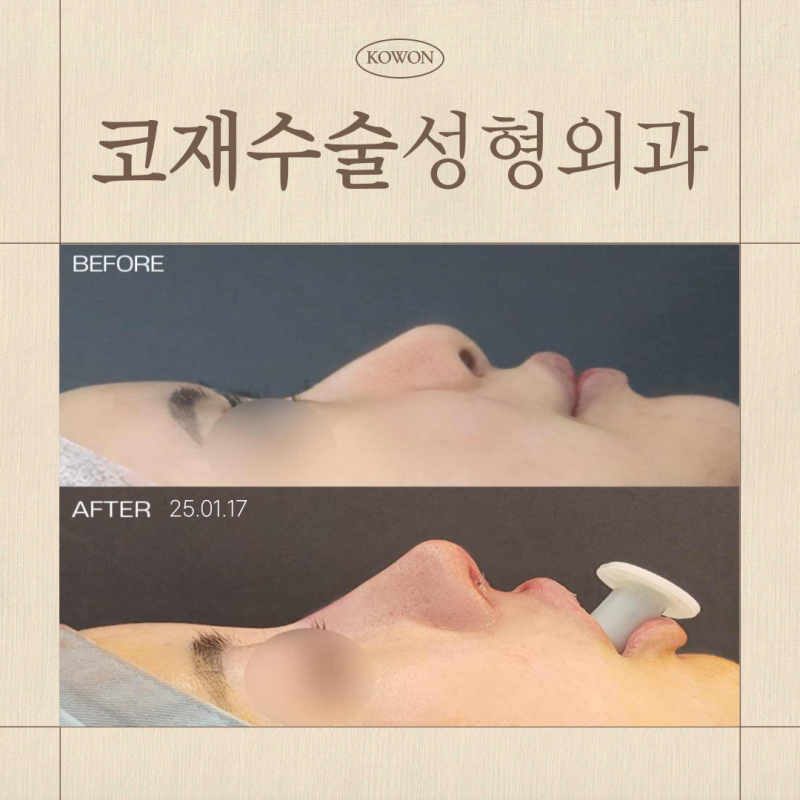 코재수술성형외과 선택 기준, 리브핏을 고려하는 이유