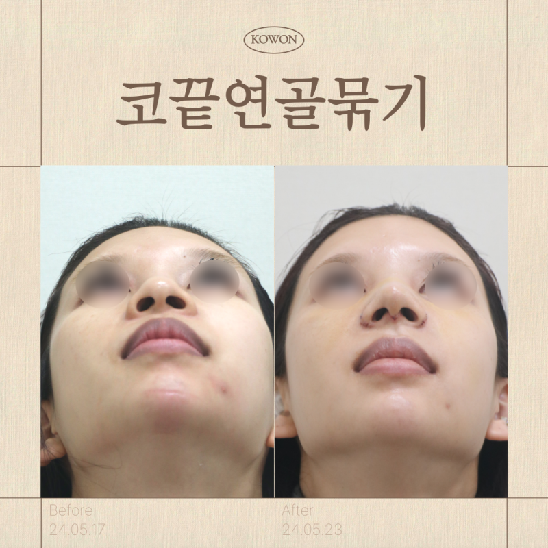 코끝연골묶기만 해도 될까? 복코 성형 결정 전 체크 기준