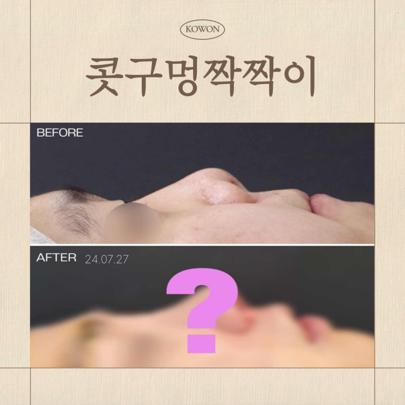 콧구멍 짝짝이, 정상인가요? 비대칭 원인과 교정 기준 정리