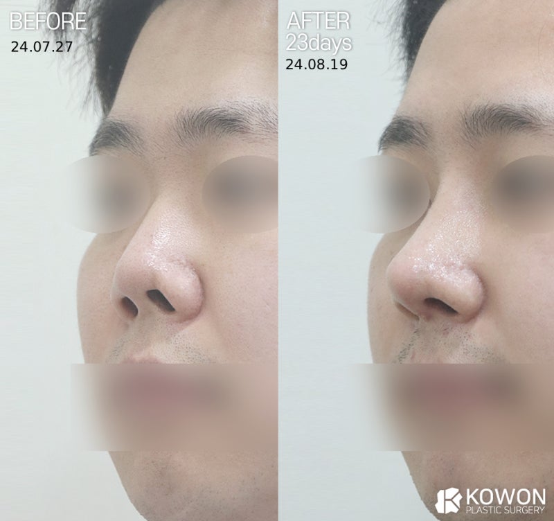 콧구멍 짝짝이, 정상인가요? 비대칭 원인과 교정 기준 정리