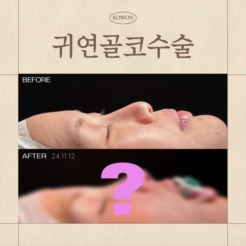 귀연골코수술, 비중격·늑연골 차이는? 코 상태별 선택 기준 정리