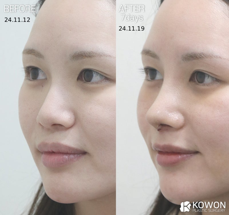 귀연골코수술, 비중격·늑연골 차이는? 코 상태별 선택 기준 정리 사진 4