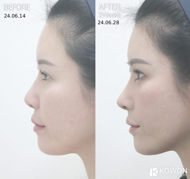 기능코성형, 비염코수술 보험보다 먼저 봐야 하는 건 숨쉬는 구조입니다 사진 3