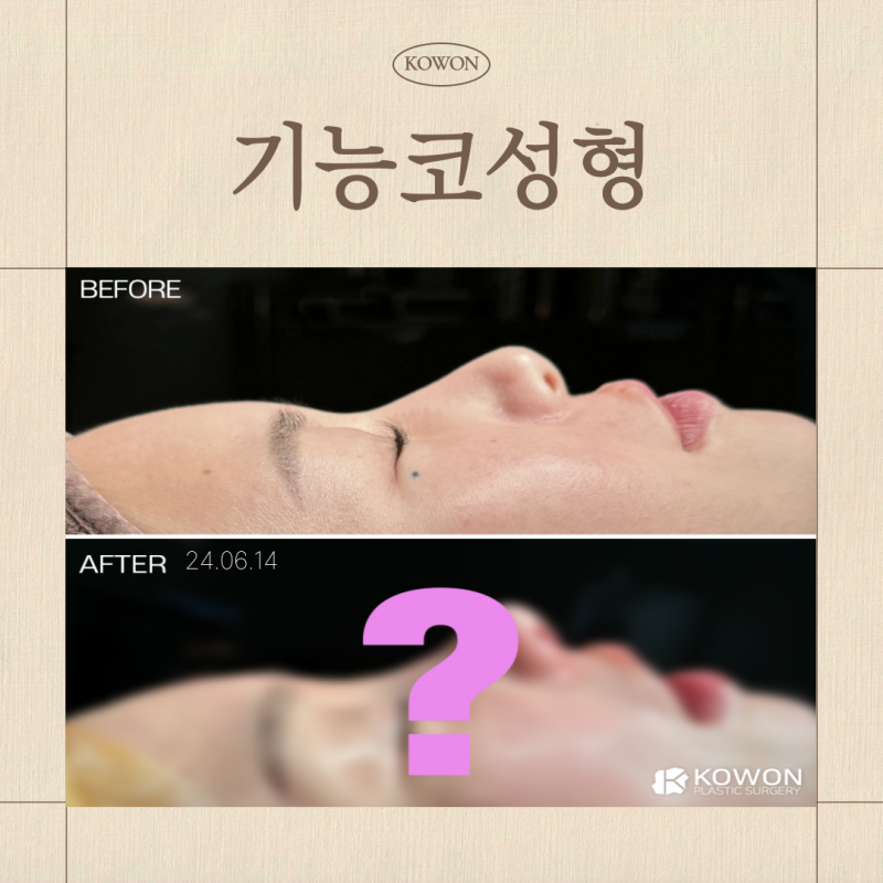 기능코성형, 비염코수술 보험보다 먼저 봐야 하는 건 숨쉬는 구조입니다