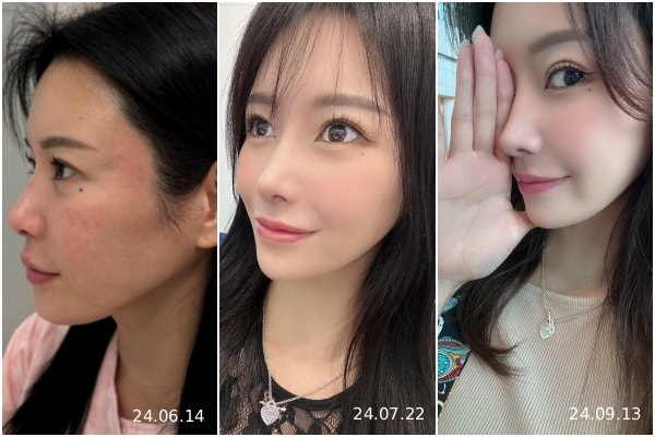 기능코성형, 비염코수술 보험보다 먼저 봐야 하는 건 숨쉬는 구조입니다 사진 5