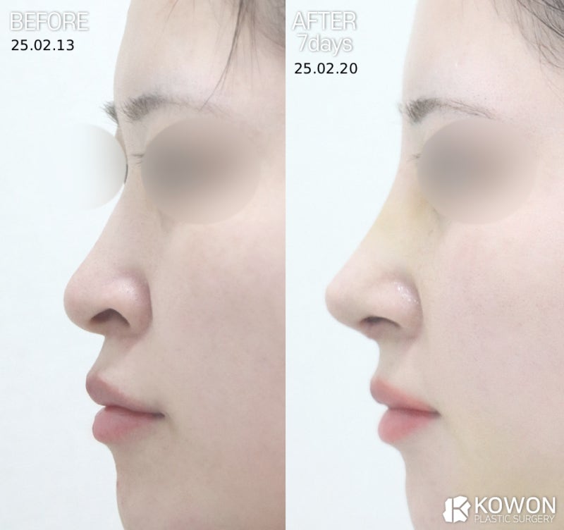 비공내리기, 들창코·용코 차이부터 수술 방향까지 한 번에 정리