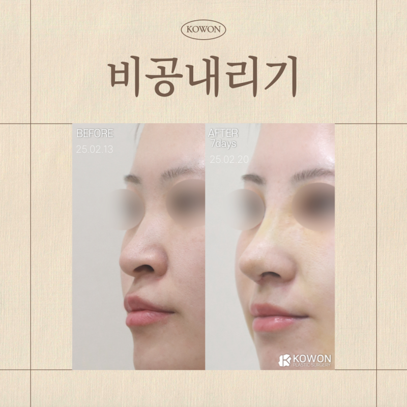 비공내리기, 들창코·용코 차이부터 수술 방향까지 한 번에 정리