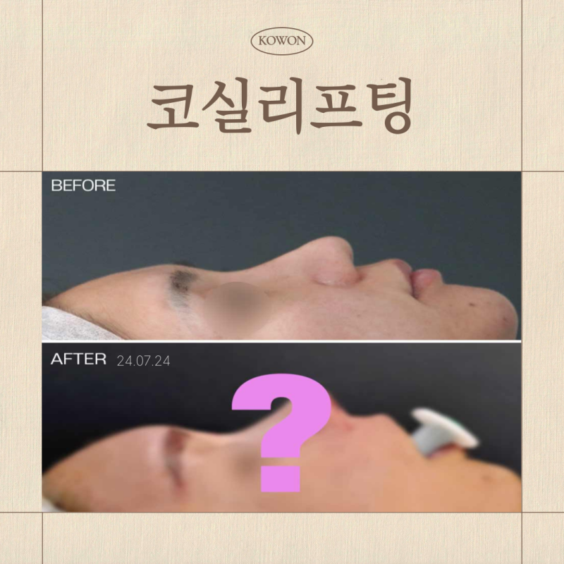 코실리프팅 왜 제거는 어려울까요? 하이코·베이코 부작용과 주의할점