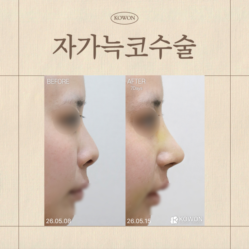 자가늑코수술 부작용, 단점, 장점 총정리, 실리콘 없이 가능한 리브핏