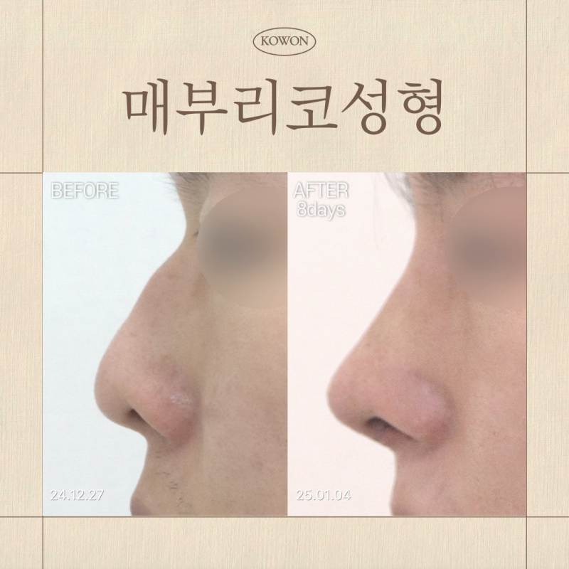 매부리코성형, 무보형물 교정 가능한 코는 따로 있습니다｜유형별 수술 방법 정리