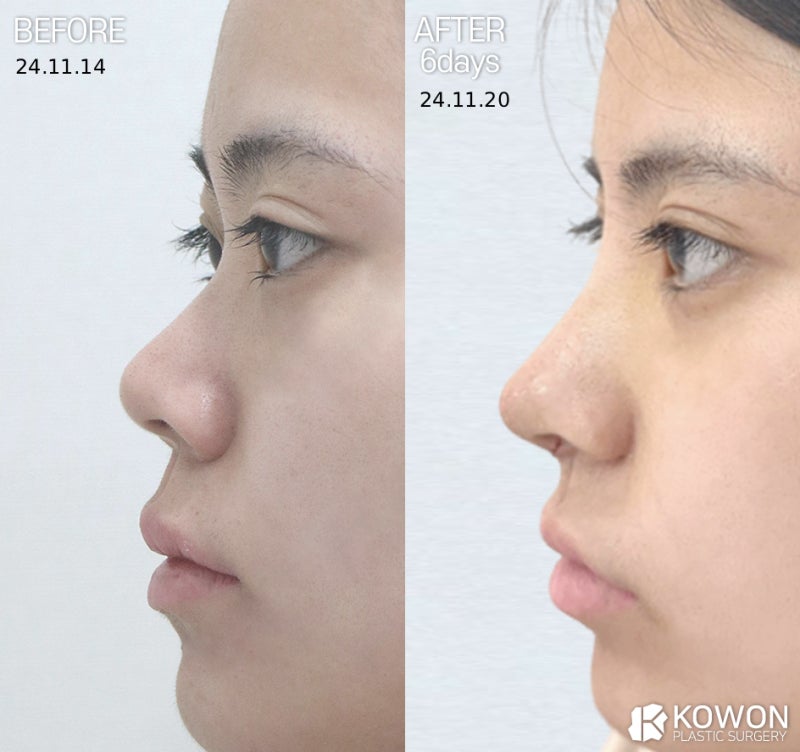 비주내리기 , 비주함몰, 짧은코 원인, 비순각만 문제가 아닙니다