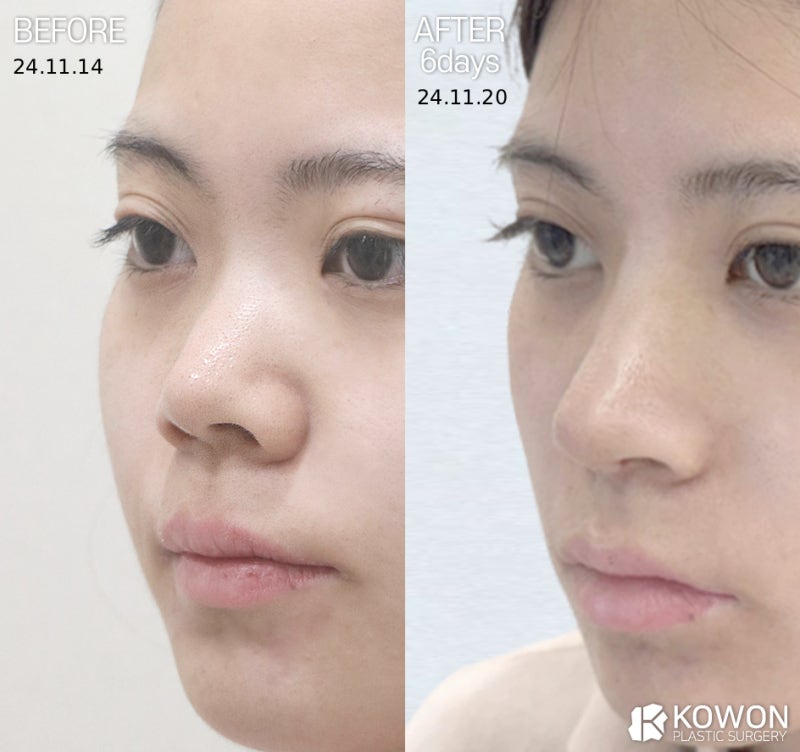 비주내리기 , 비주함몰, 짧은코 원인, 비순각만 문제가 아닙니다 사진 3