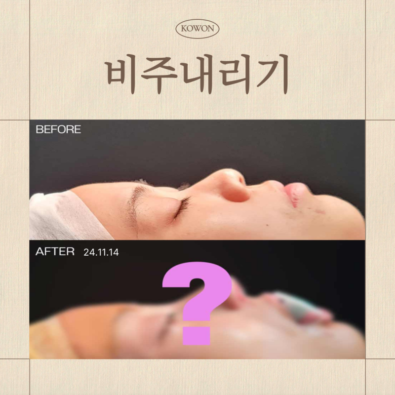비주내리기 , 비주함몰, 짧은코 원인, 비순각만 문제가 아닙니다