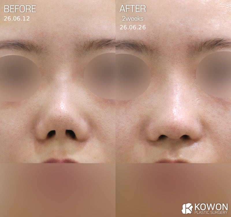 코재수술잘하는곳 선택 기준, 코끝재수술·코끝들림 원인부터 판단까지 정리 사진 4