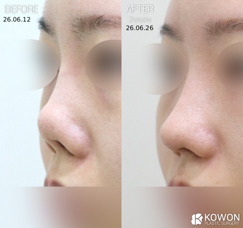 코재수술잘하는곳 선택 기준, 코끝재수술·코끝들림 원인부터 판단까지 정리