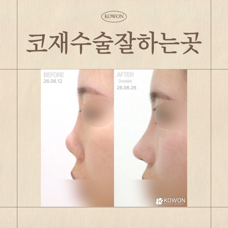 코재수술잘하는곳 선택 기준, 코끝재수술·코끝들림 원인부터 판단까지 정리