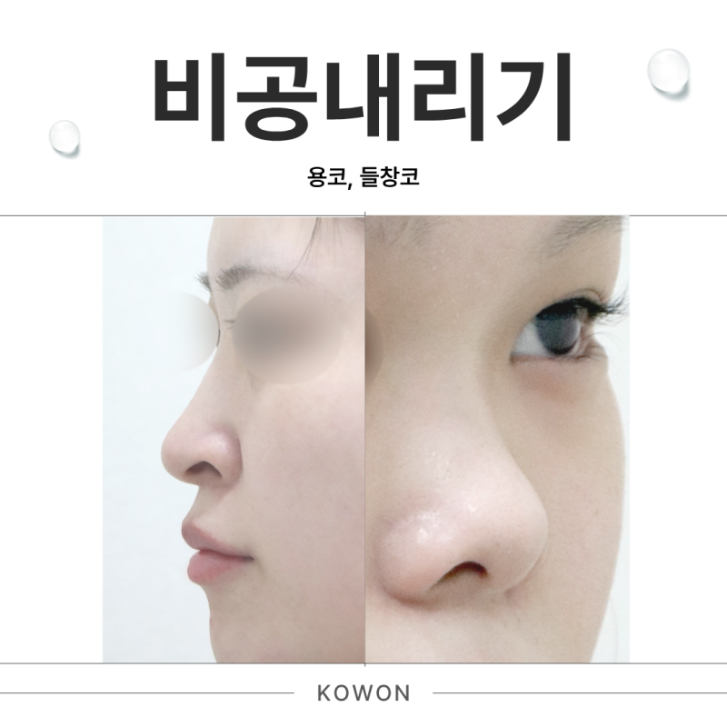 신사역성형외과 비공내리기, 용코 들창코 수술 전 코끝과 콧구멍 확인 기준