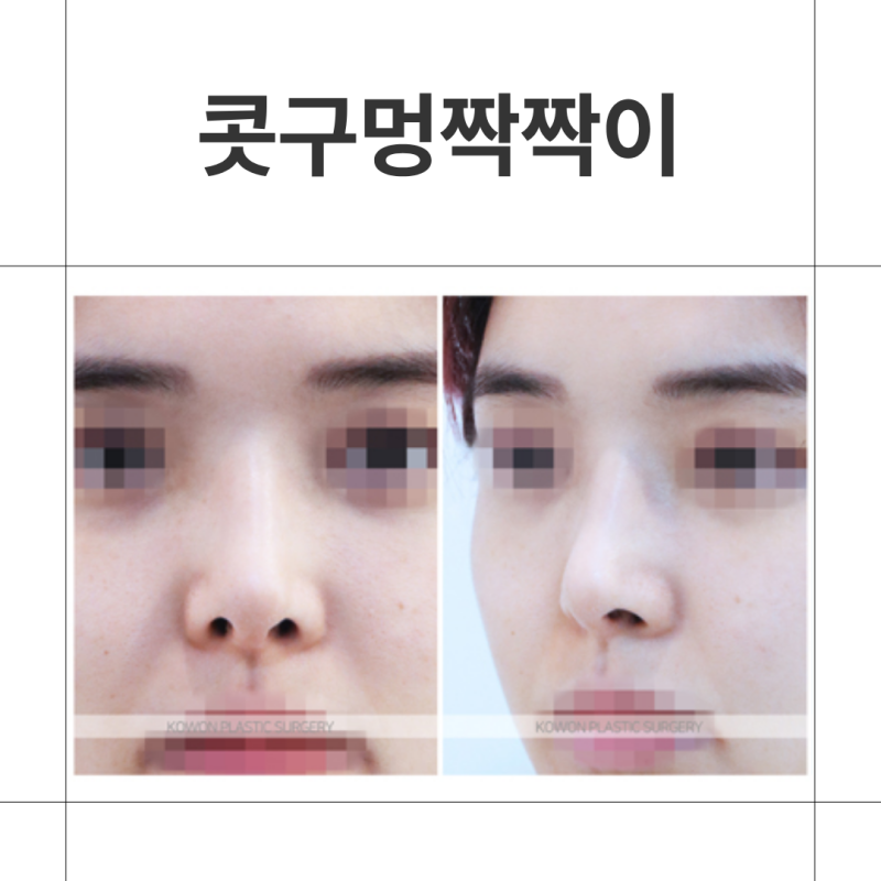 코수술 후 콧구멍 짝짝이 비대칭 언제까지 지켜봐야 할까