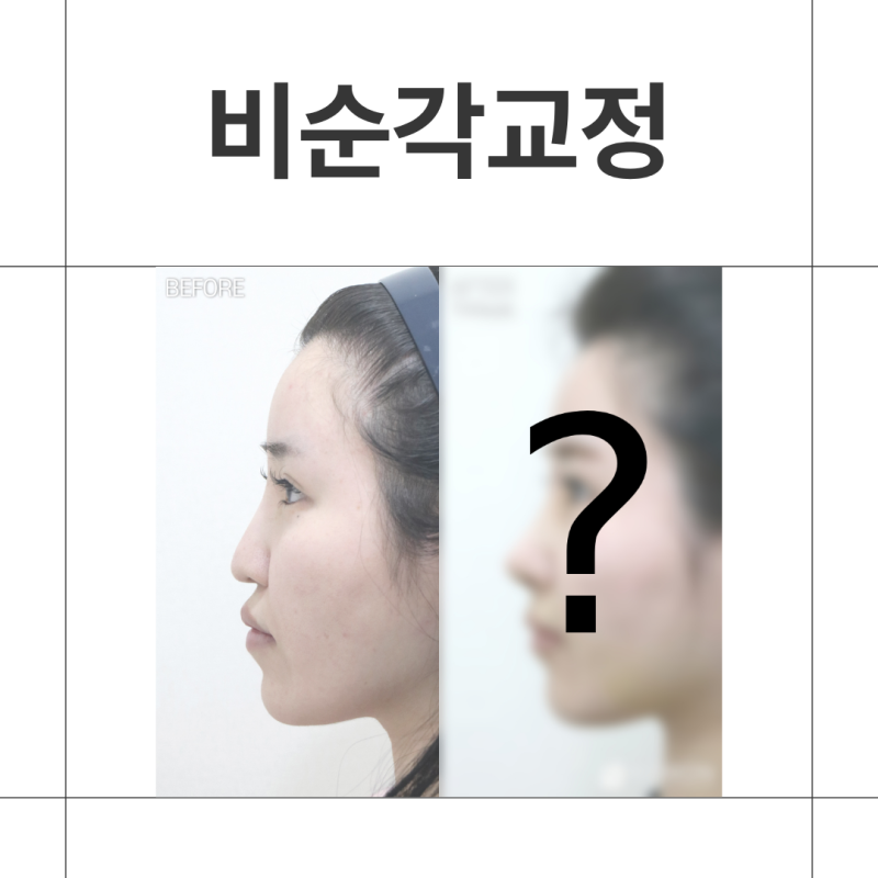 강남 비순각교정 잘하는곳 코수술로 보는 돌출입교정 효과