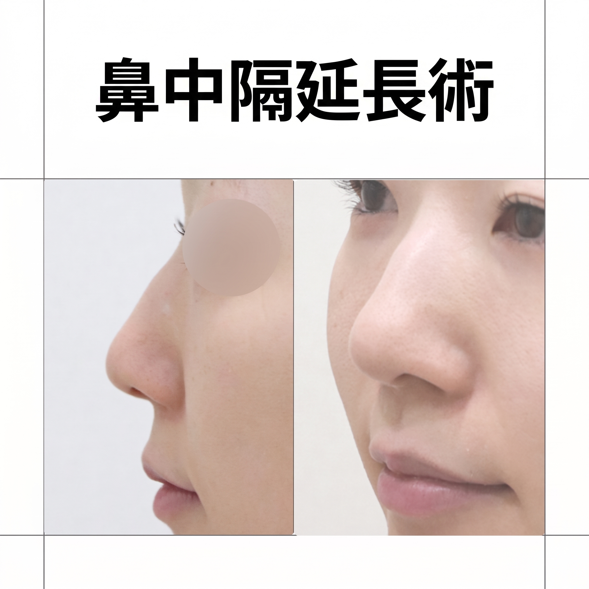 鼻柱下降術、鼻柱陥凹・鼻唇角・小鼻まで見極めるべき理由
