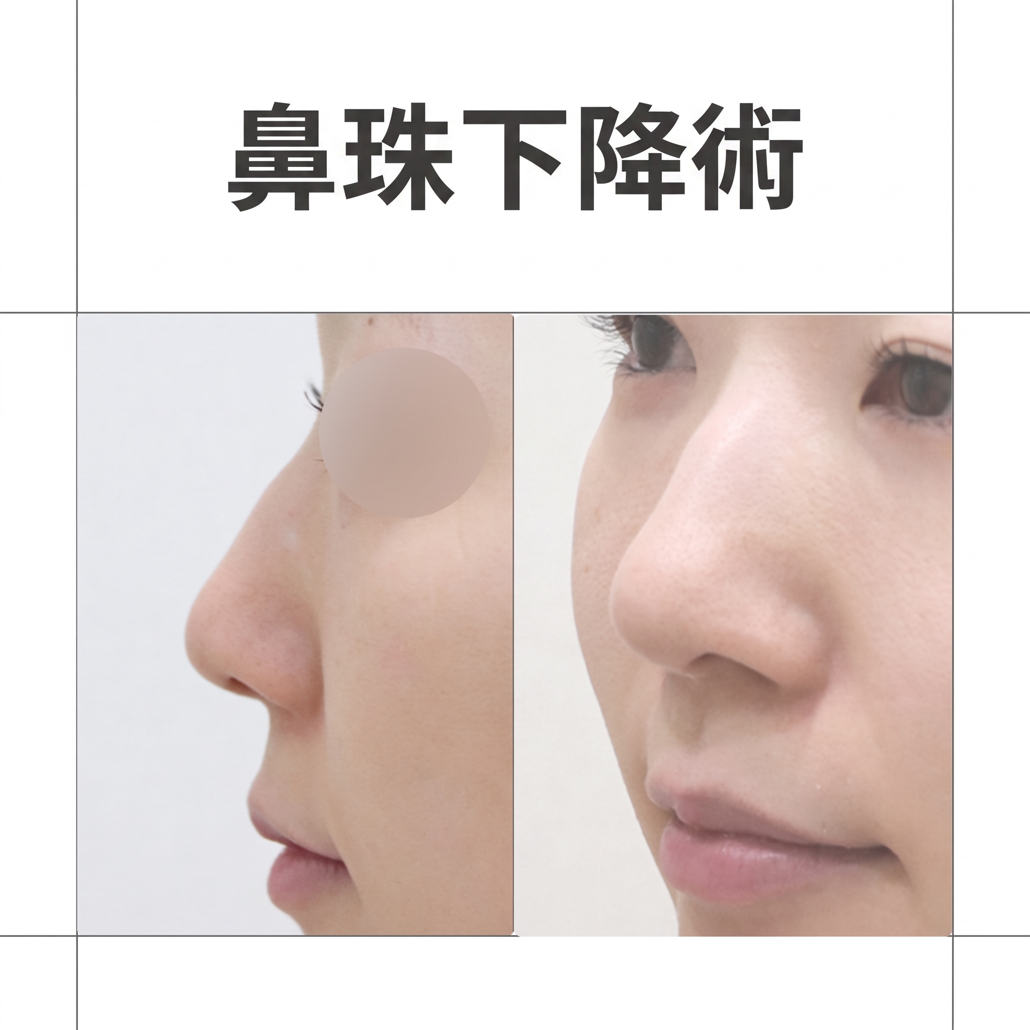 鼻柱下移術、鼻柱凹陷：為何需要同時考量鼻唇角與鼻翼？