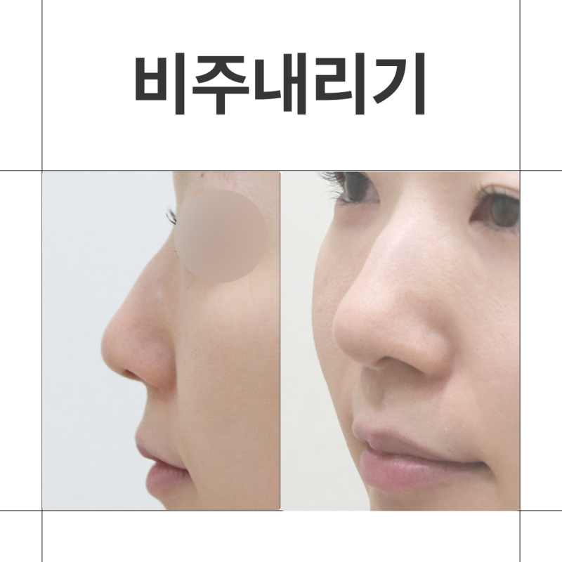 비주내리기, 비주함몰 비순각과 콧날개까지 살펴보는 이유