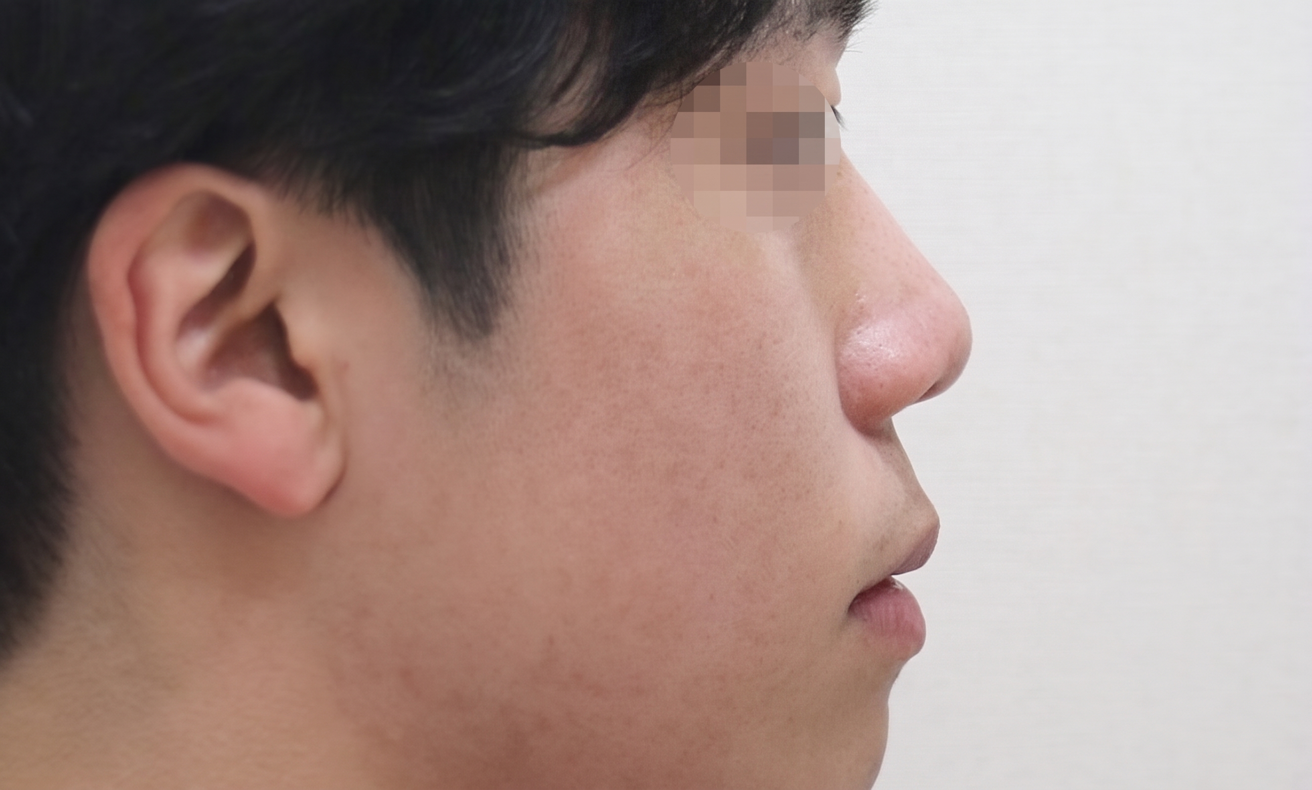 鼻柱下移術、鼻柱凹陷：為何需要同時考量鼻唇角與鼻翼？ 사진 3