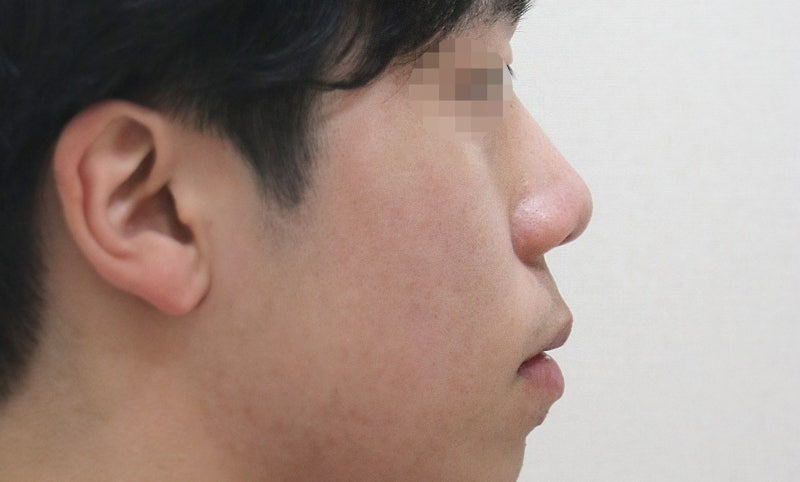 비주내리기, 비주함몰 비순각과 콧날개까지 살펴보는 이유 사진 3