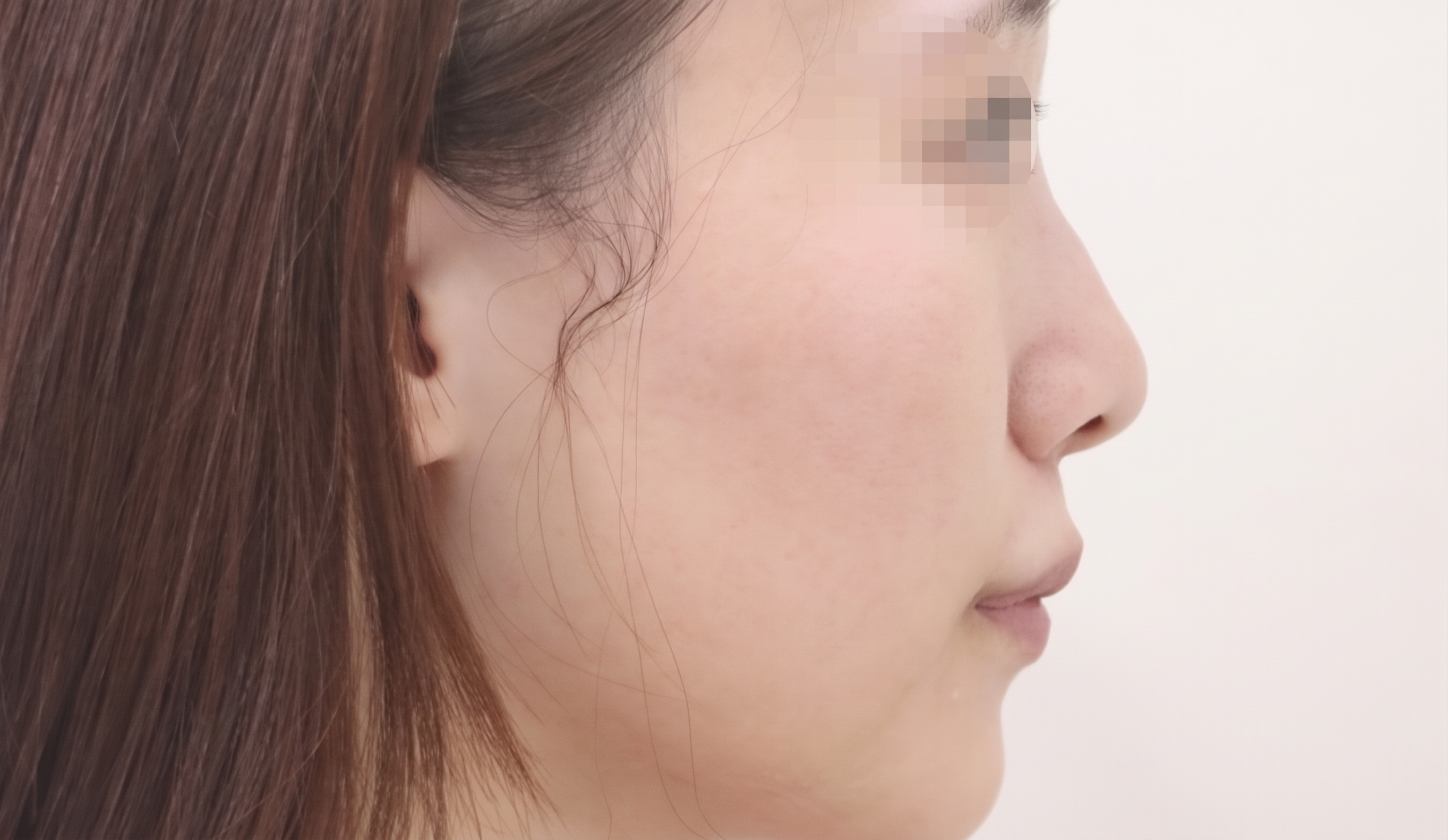 鼻柱下移術、鼻柱凹陷：為何需要同時考量鼻唇角與鼻翼？ 사진 2