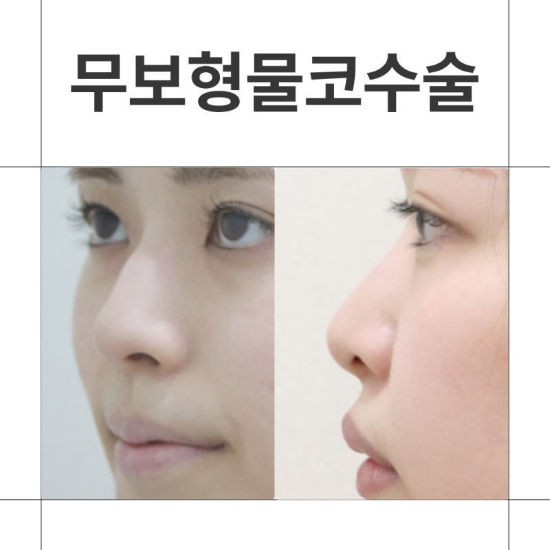 무보형물코수술, 자가늑과 자가조직으로 콧대 라인 만드는 방법