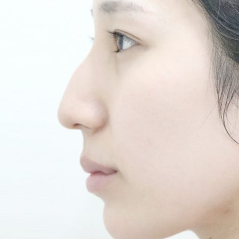 매부리코수술 방법, 코끝처짐 원인과 근육교정까지 사진 4