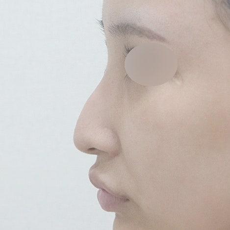 매부리코수술 방법, 코끝처짐 원인과 근육교정까지 사진 3