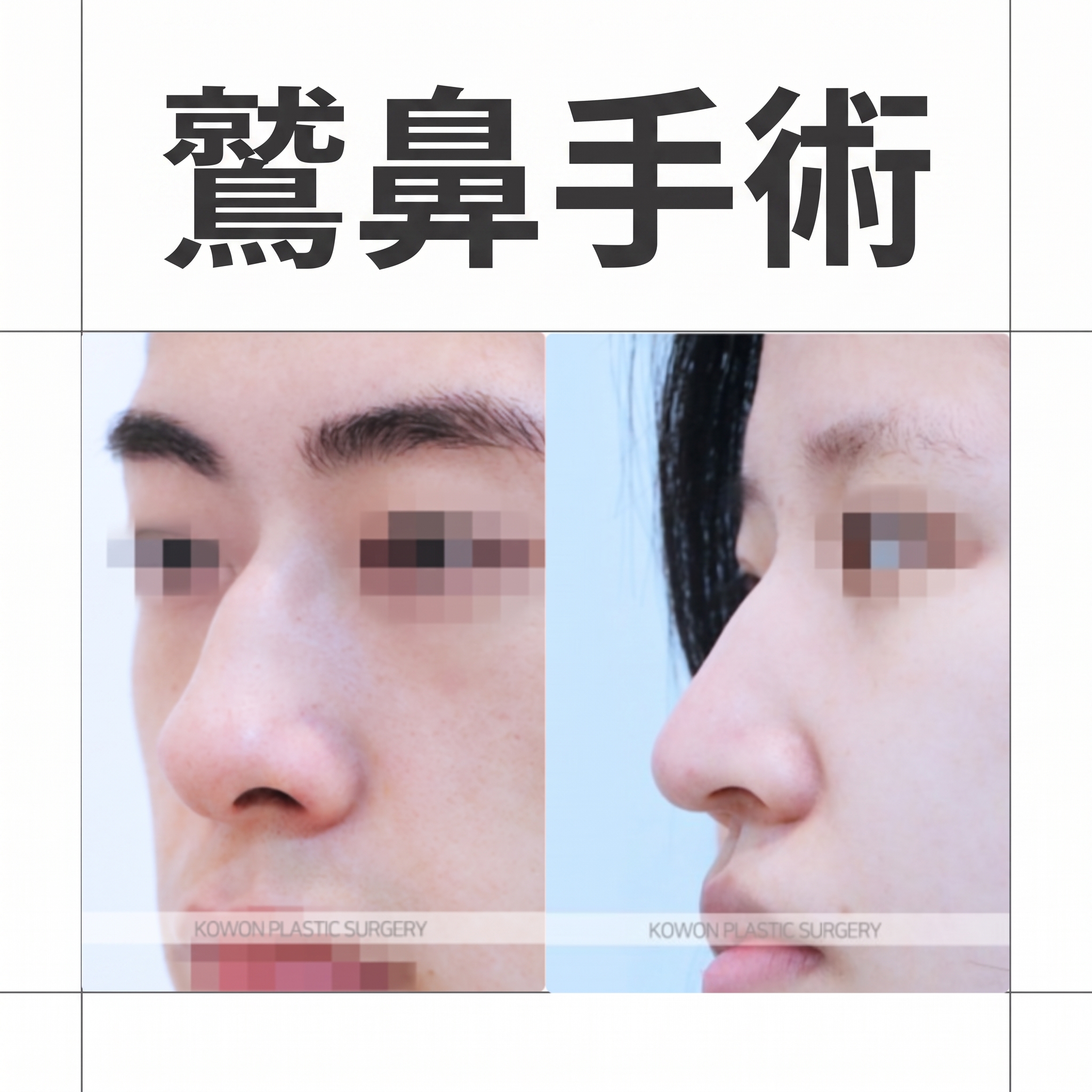 鷲鼻の手術方法と鼻先の下垂の原因、筋肉矯正まで