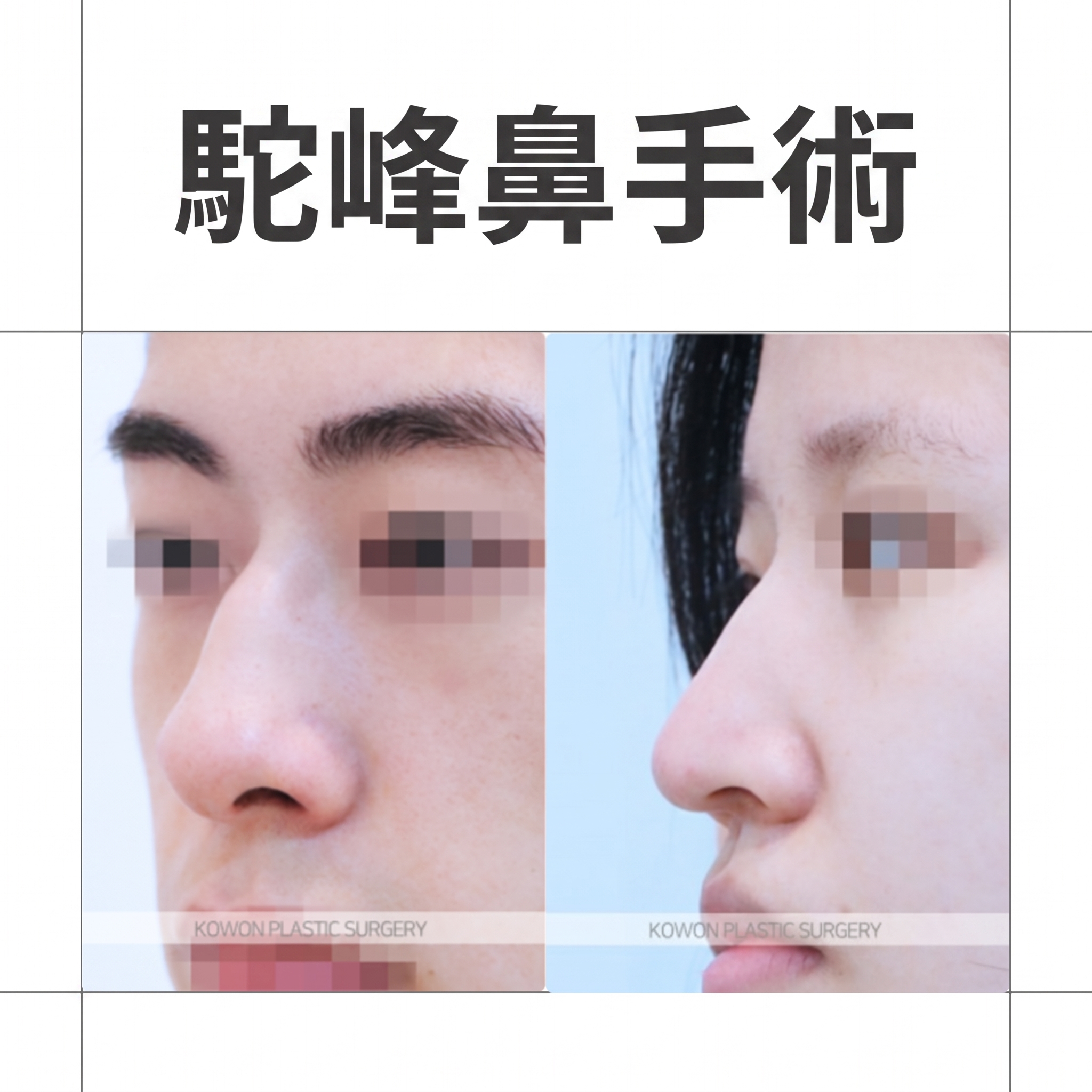 駝峰鼻手術方法、鼻尖下垂原因與肌肉矯正