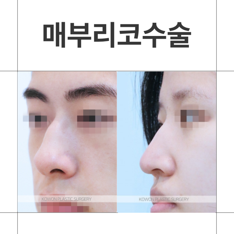 매부리코수술 방법, 코끝처짐 원인과 근육교정까지